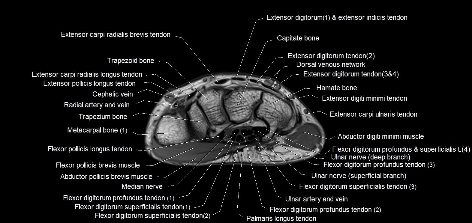MRI 3T  hand axial labelled cross sectional anatomy imagemy  5.webp